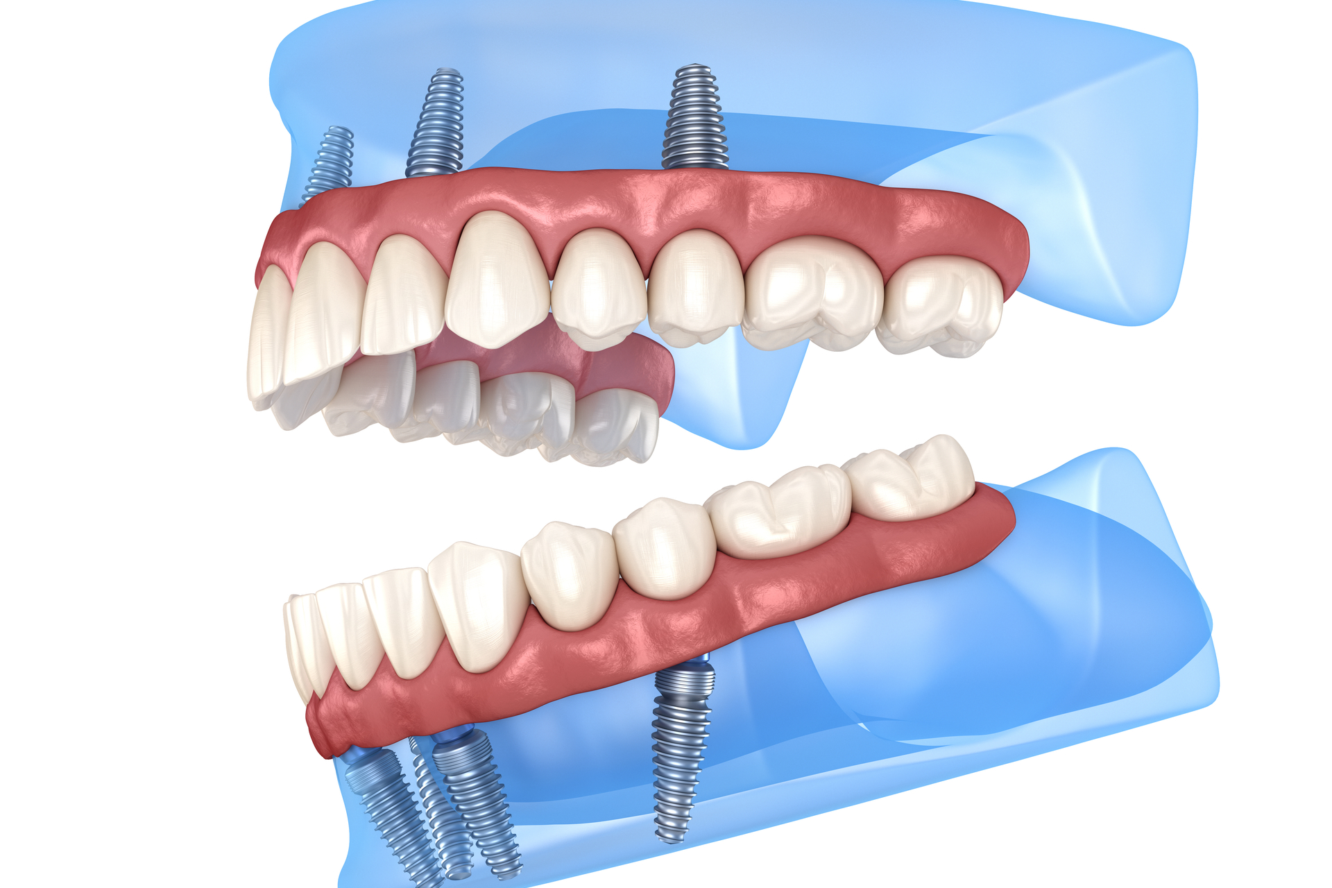 Dental Implant Center Debunks 5 Dental Implant Myths All On 4 Dental