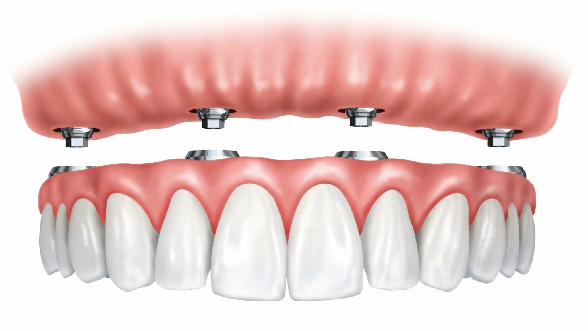 Do You Need Full Arch Or Single Dental Implants Fastnewsmile Dental Implant Centers