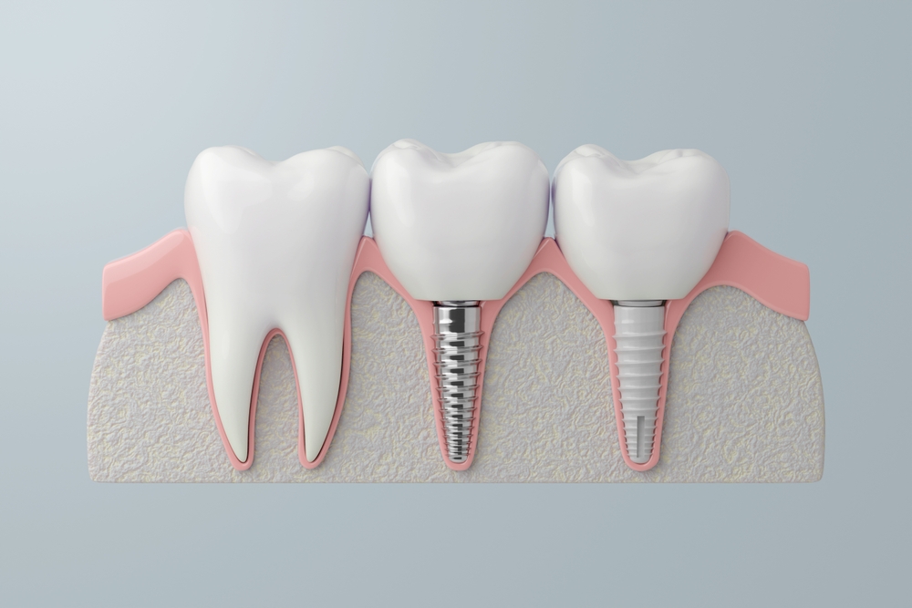 Titanium and Zirconia Implant Comparison